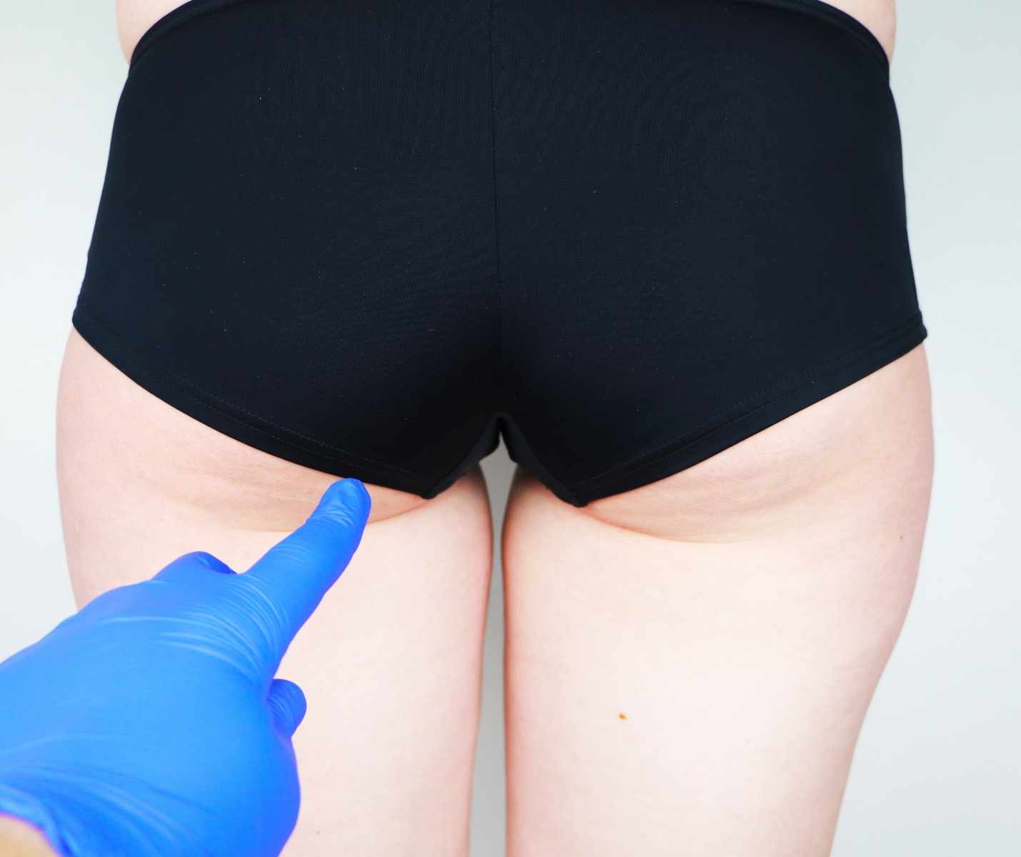 Gluteoplastica Intervento Chirurgo Plastico Medicina estetica