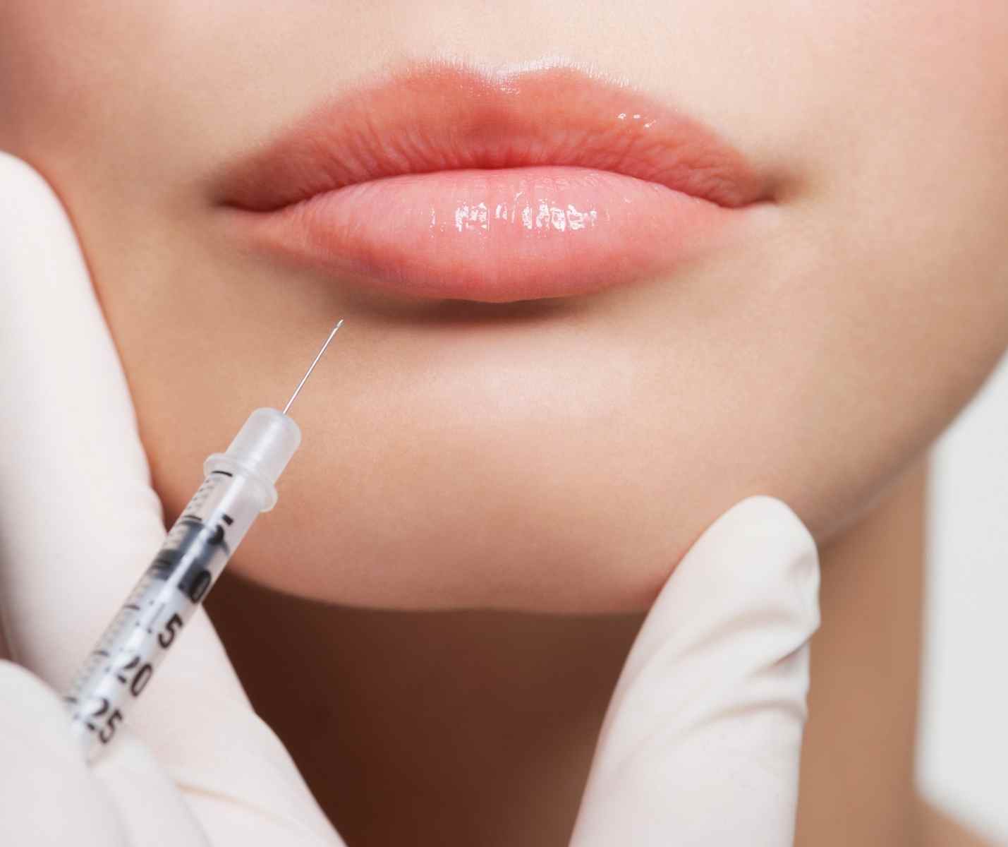 botox labbra medicina estetica